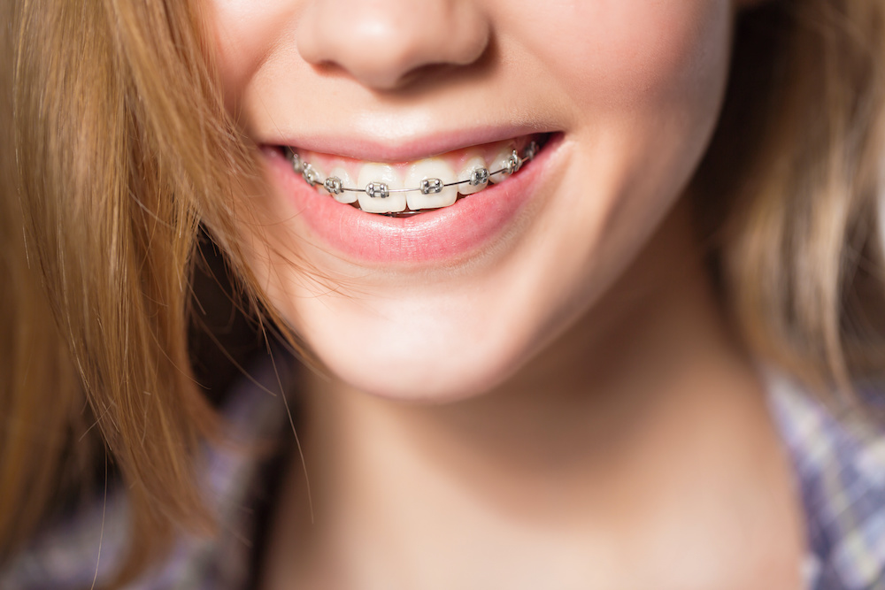 Let a Midlothian orthodontist correct your bite pattern with Invisalign or braces