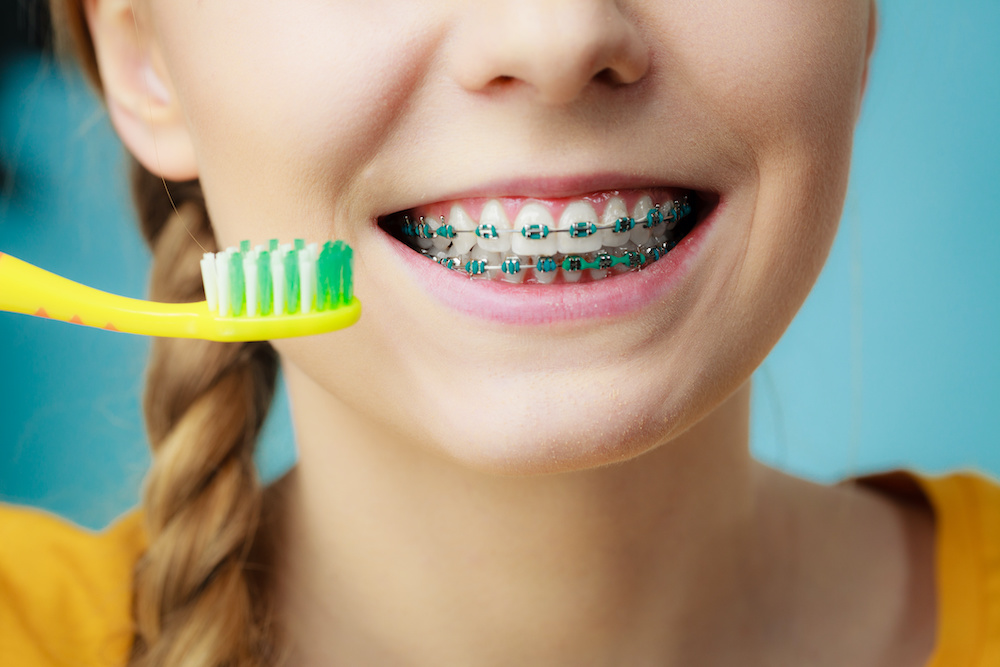 Dentist and orthodontist concept. Young woman with blue braces cleaning and brushing teeth using manual toothbrush, traditional brush