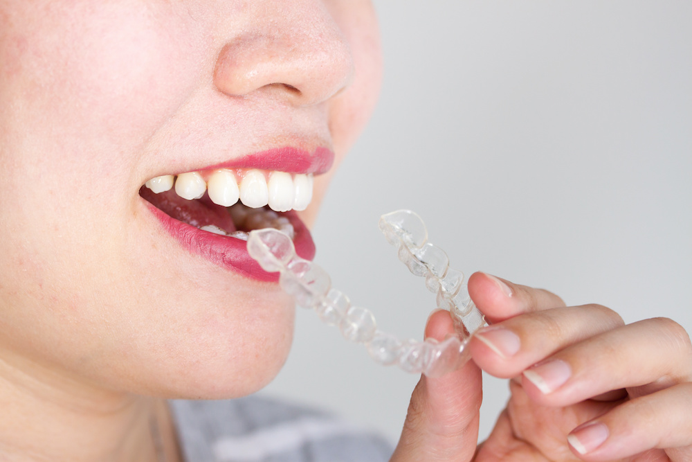 Close up view of a woman putting on invisalign braces
