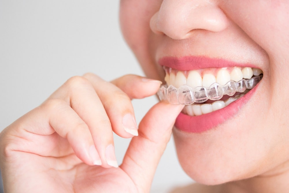 Dabney Orthodontics in Midlothian explain Invisalign attachements and how they work
