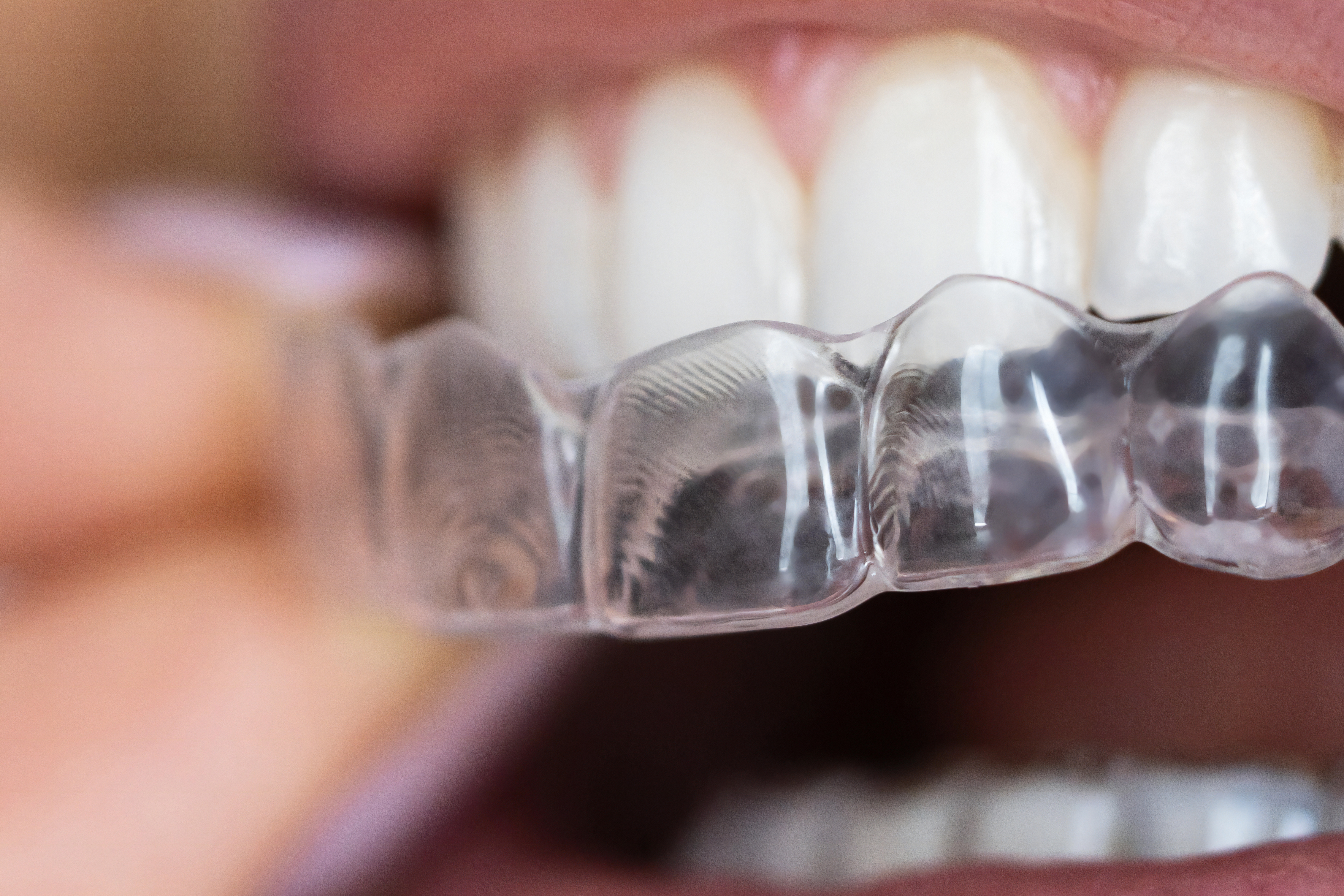Clear Dental Aligners - Night Guard for Perfect Alignment